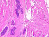 Ameloblastic Fibroma - Bone Epithelium Fibrous