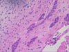 Ameloblastic Fibroma - Epithelial Strands