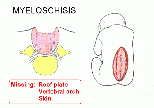 Myeloschisis