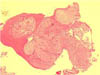 Ameloblastic Fibroma - General Picture