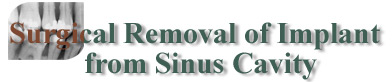 Surgical Removal of Implant from Sinus Cavity